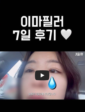 이마필러 맞고 아바타 된 후기