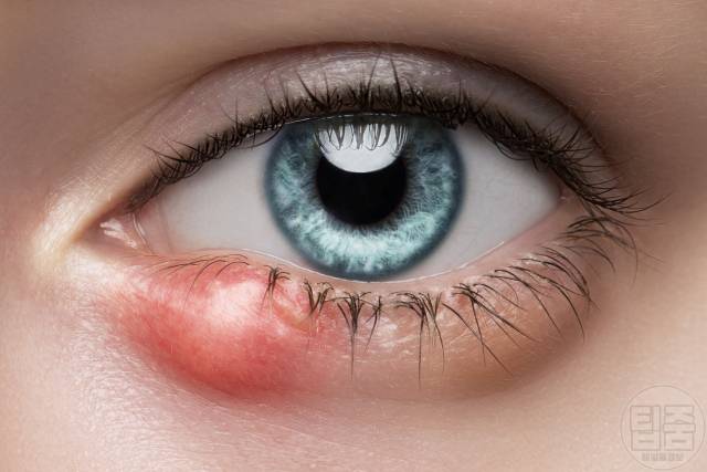 눈이 붓는 이유 눈 붓기가 안빠져요 눈붓기 원인 그레이브스병 눈감염 다래끼