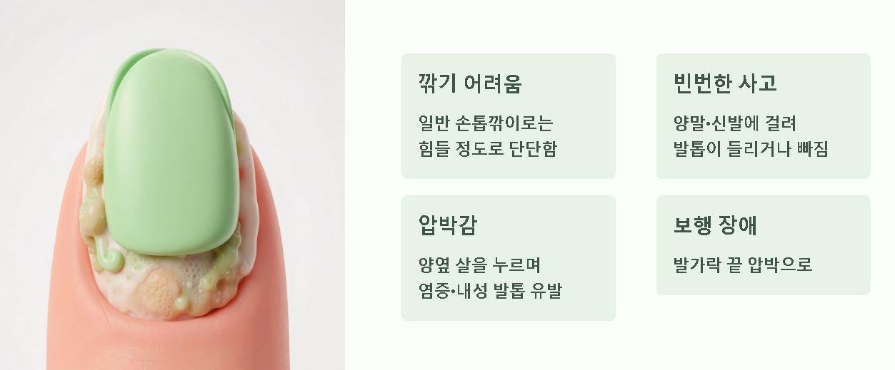 발톱 무좀 증상 초기신호