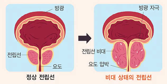 전립선비대증 치료