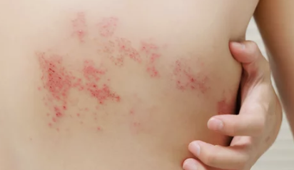 대상포진