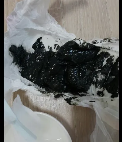 검은 변 원인 위장 출혈 가능성 있는 소화기 질환 정리_2