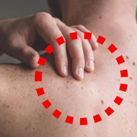 여드름이-등에-나있는-여자-사진