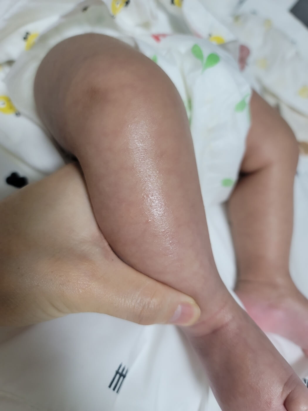 어린선 피부비늘증 현상 완화