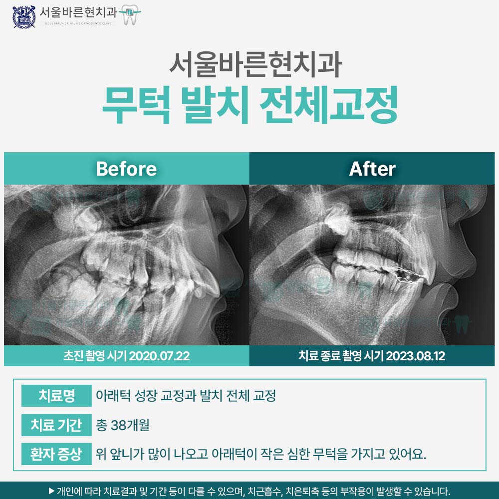 해운대소아교정