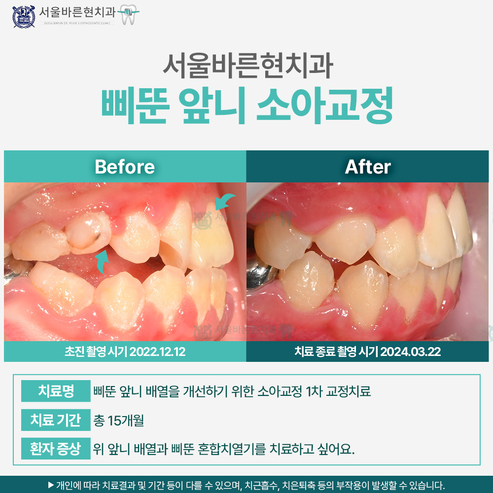 부산소아앞니교정