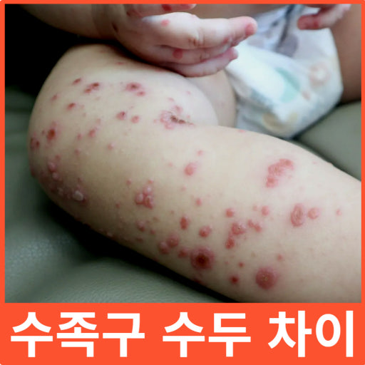 수족구와 수두의 차이점