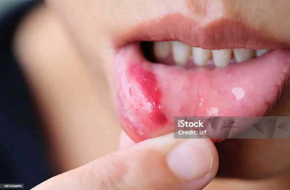 베체트병, ‘진짜 진단’은 이렇게 합니다|혈액검사·HLA-B51 정리