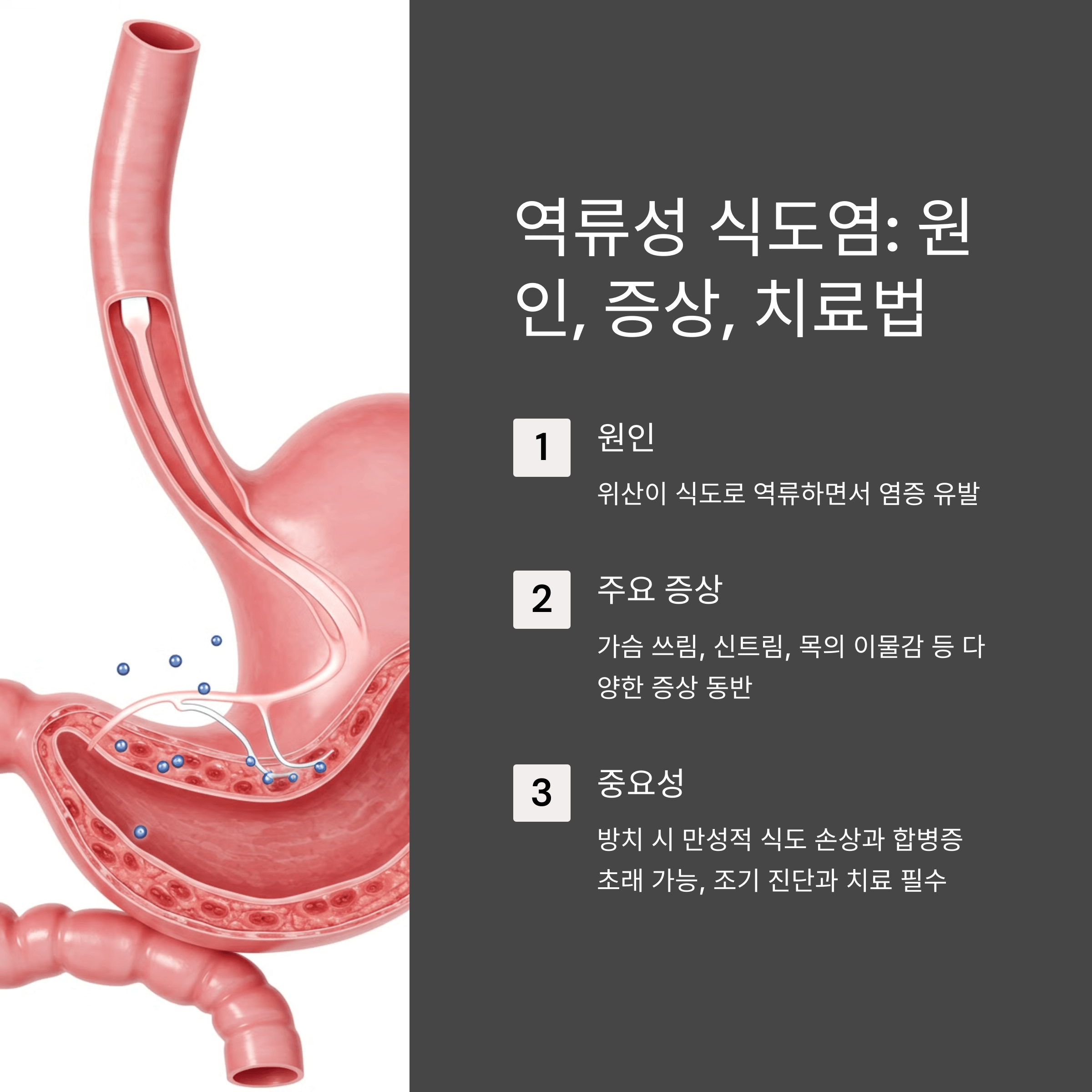 역류성 식도염 원인과 증상