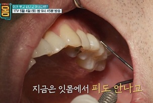 잇몸피안남