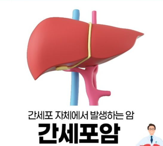 간세포암