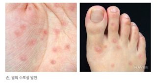 수족구병 감염 경로와 전파력