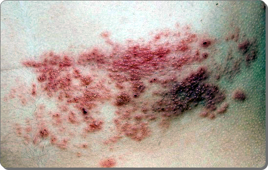 대상포진 초기증상 16