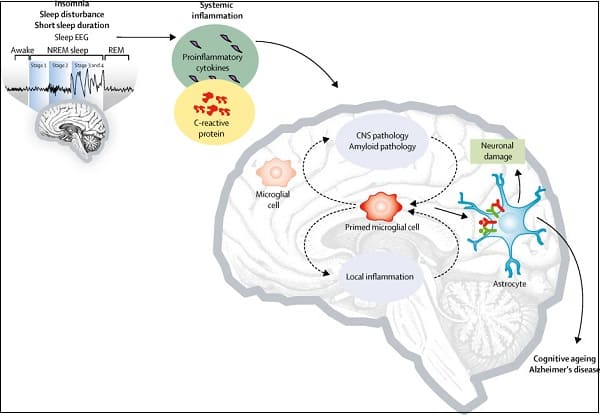 불면증이라면, 치매? Approach to insomnia in patients with dementia