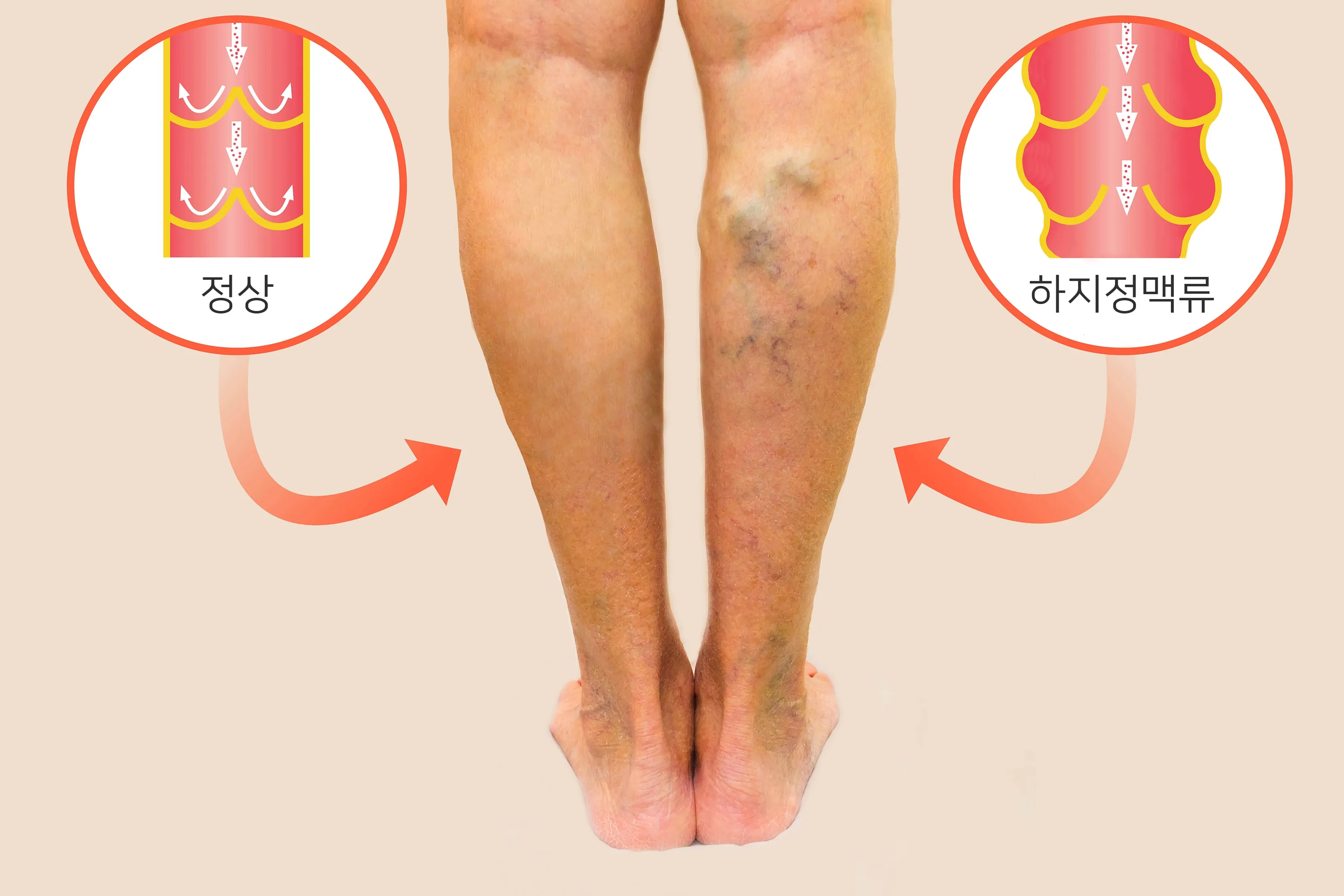 하지 정맥류 증상 치료방법과 예방 생활습관_1
