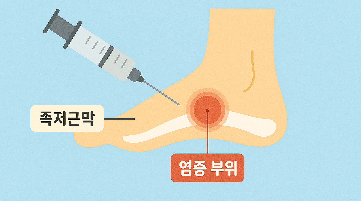 족저근막염 주사치료