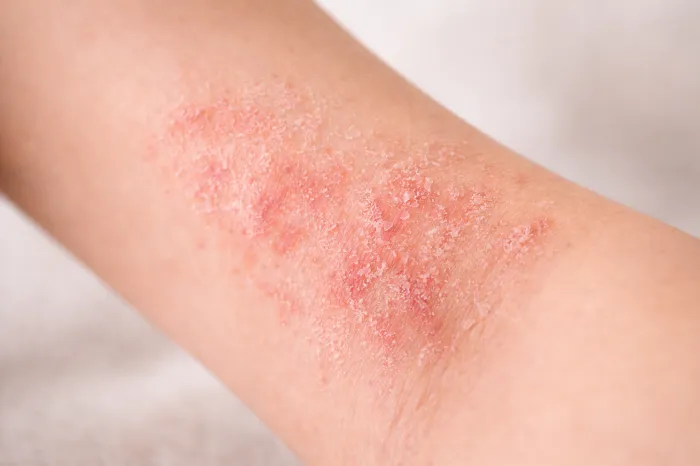 피부에 붉은반점이 생기는 이유