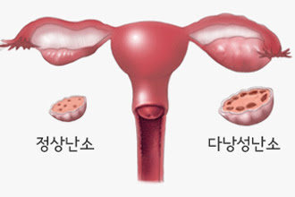 다낭성 난소 증후군