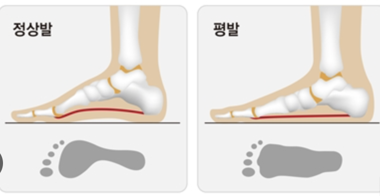 평발(3)