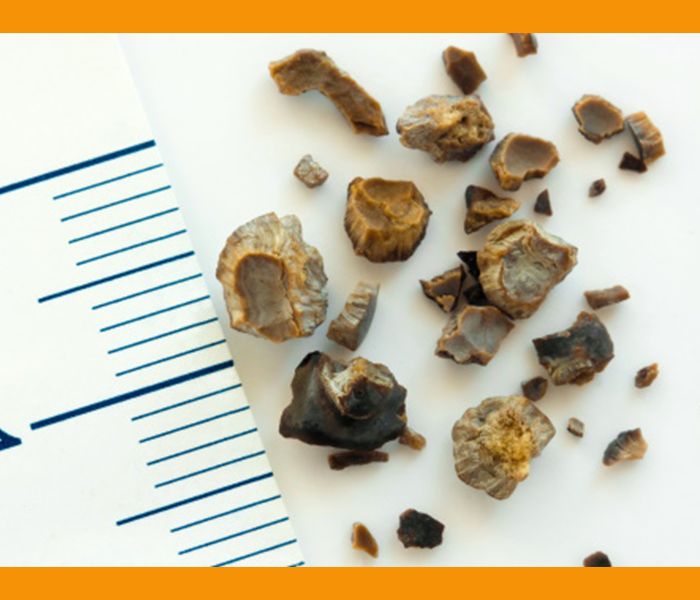 오른쪽 옆구리 통증 원인 - 요로결석