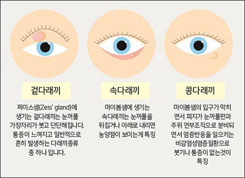 다래끼 치료 11