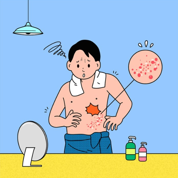 대상포진 이미지 사진