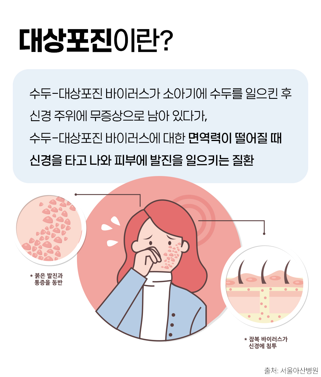 # 대상포진이란? 면역력이 떨어질 때 신경을 타고 나와 피부에 발진을 일으키는 질환