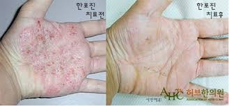 습진 가려움 집에서 응급 처치하는 방법