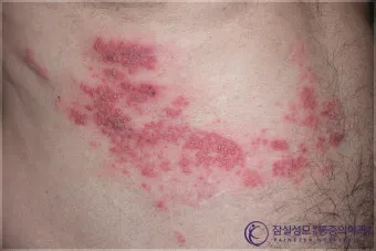 경기도 대상포진 무료접종 연령 기준 정리로 안내_10