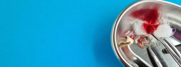 사랑니 발치 후 식사&#44; 드라이 소켓이 생기는 이유에 대해 알아봤습니다. 사랑니 위치와 발치를 한 후에 조심해야 할 사항들&#44; 사랑니를 발치하지 않으면 생기는 질병까지 꼼꼼히 읽어 보시기 바랍니다.