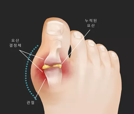 통풍-원인