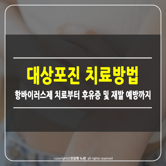 대상포진 치료방법