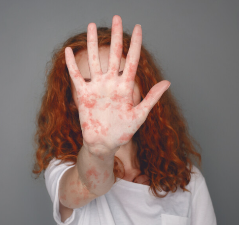 홍역 증상 완벽 가이드