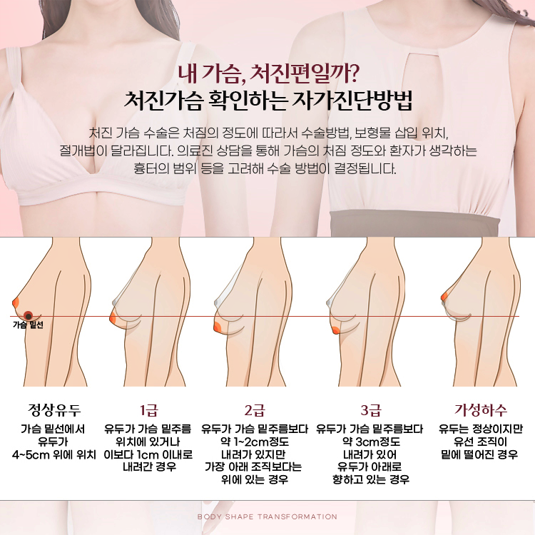 처진가슴수술은 처짐의 정도에 따라서 수술방법, 보형물 삽입위치, 절개법이 달라집니다. 의료진 상담을 통해 가슴의 처짐 정도와 환자가 생각하는 흉터의 범위 등을 고려해 수술 방법이 결정됩니다.
