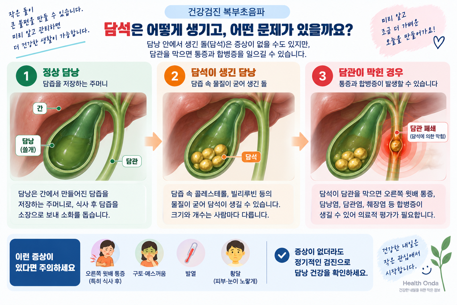 담석이 담관을 막는 과정과 통증&middot;구토&middot;발열&middot;황달을 설명하는 그림