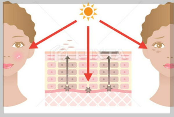 기미-자외선원인