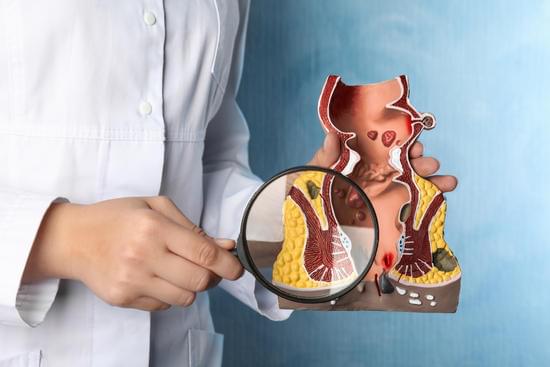 치질(hemorrhoids)