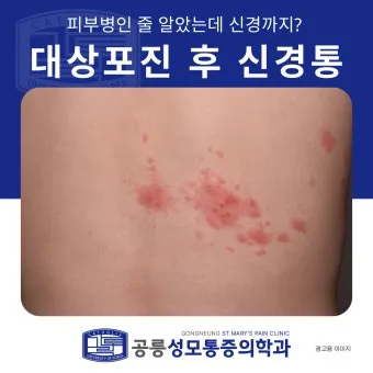 경기도 대상포진 무료접종 연령 기준 정리로 안내_18