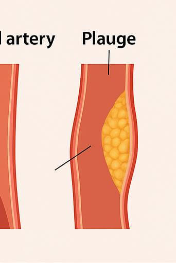 동맥경화증 초기증상 / 동맥경화에 좋은 음식 / 동맥경화 치료법