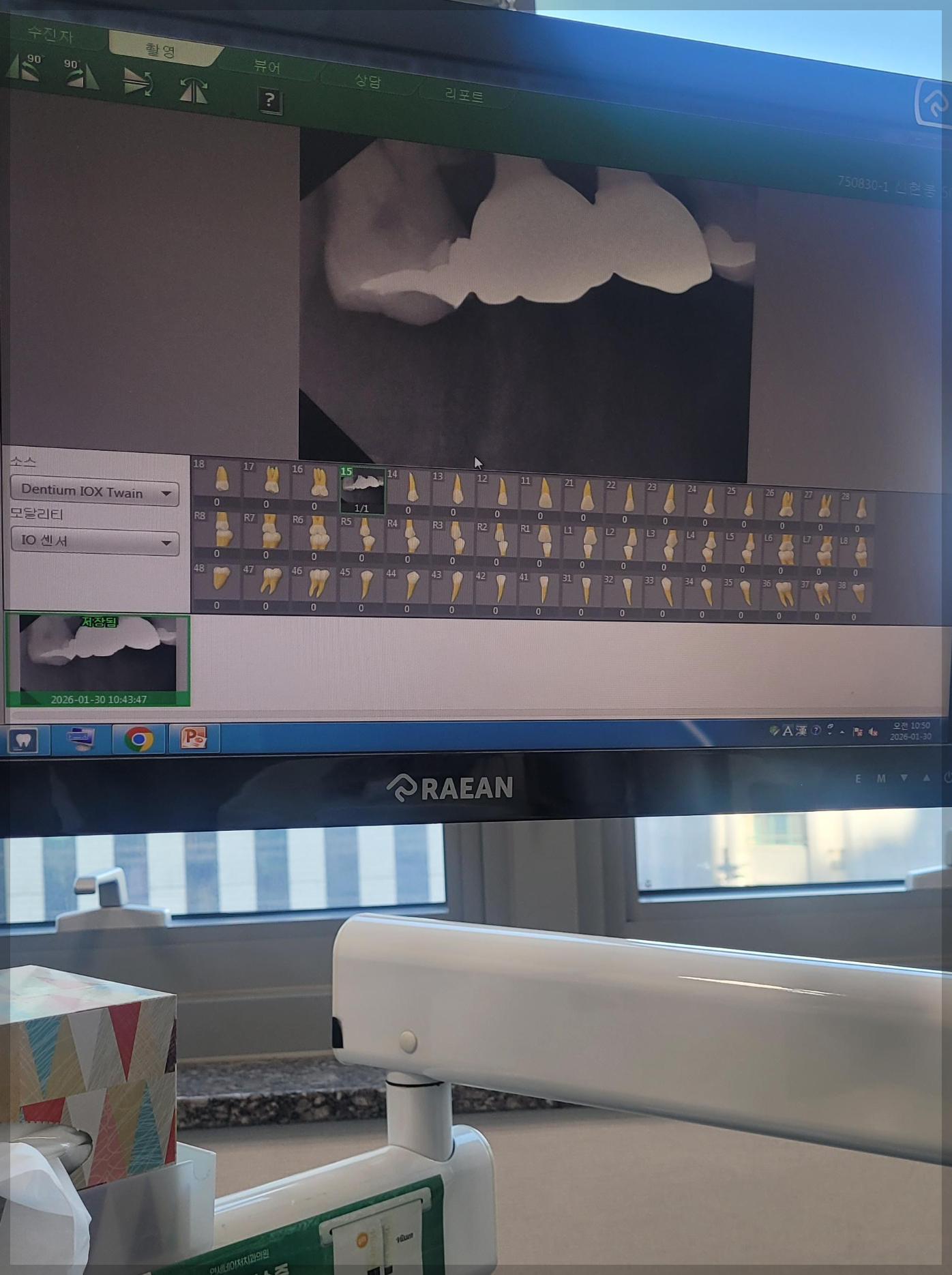 내치아엑스레이