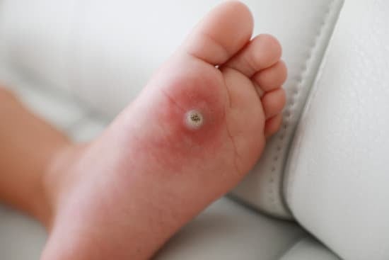 발바닥 사마귀 (Plantar Wart) – 원인, 증상, 치료법 총정리