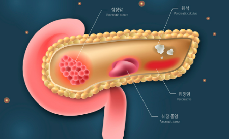 췌장암 원인