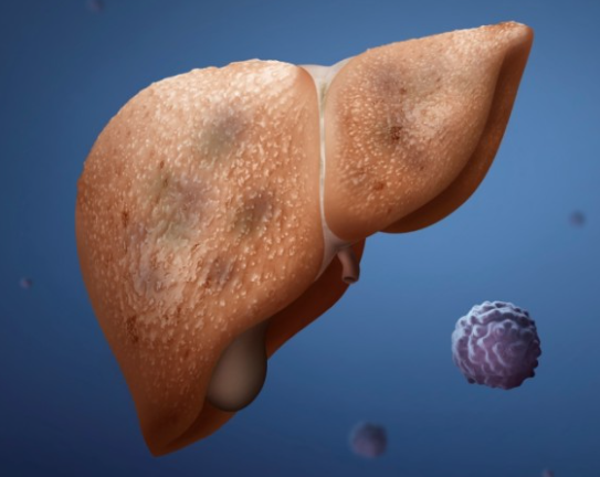 간경변 진행중인 간