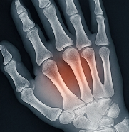 관절염에 좋은 음식