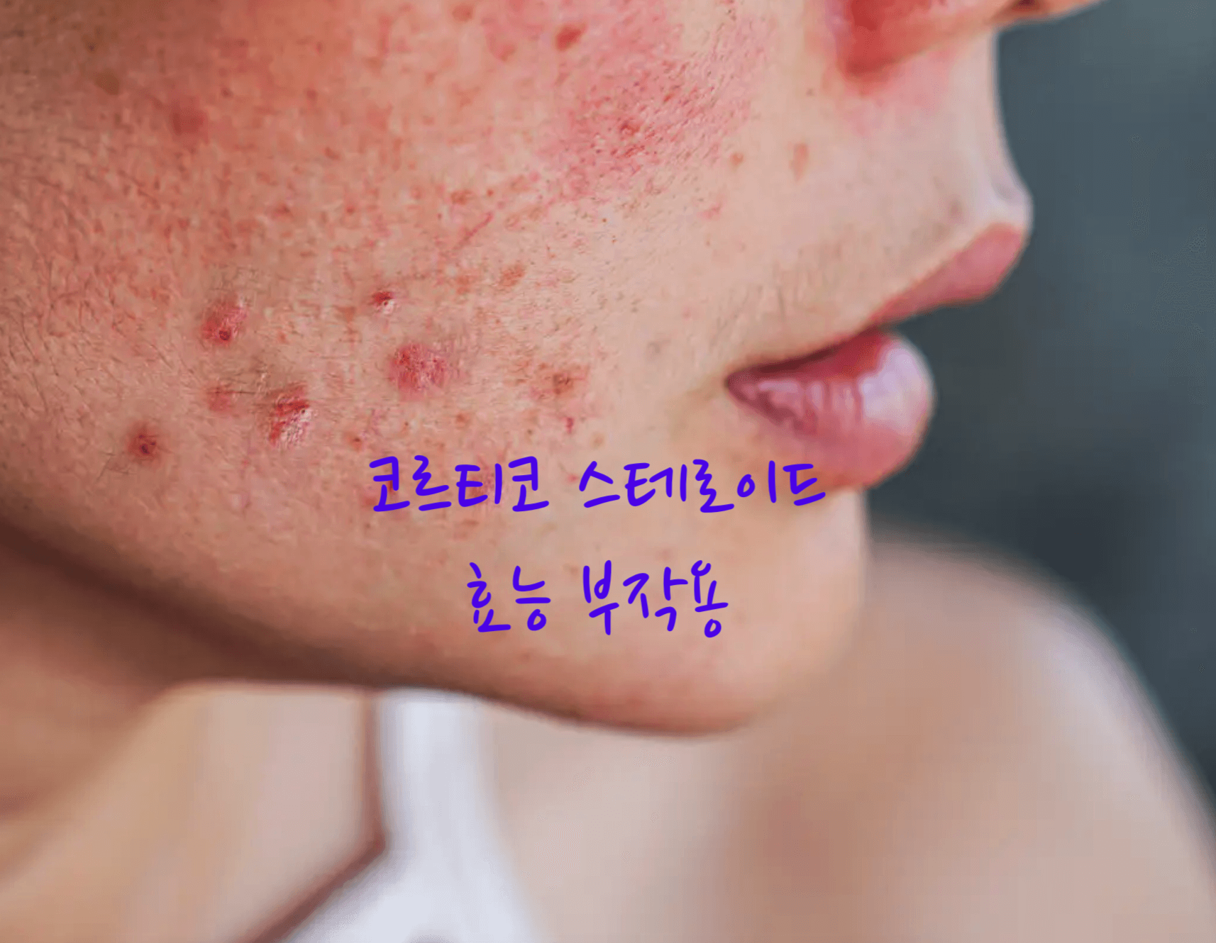 코르티코 스테로이드