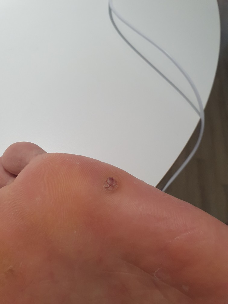 발바닥티눈사진