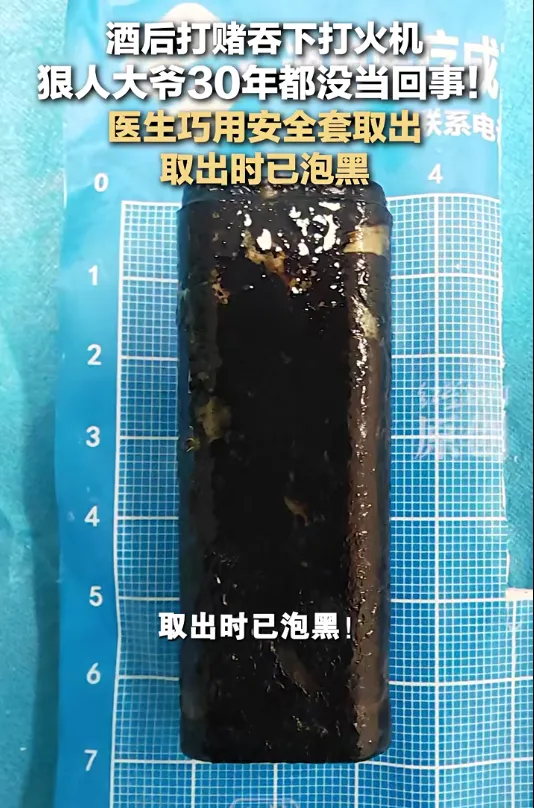 술자리 내기로 &lsquo;라이터 삼킨&rsquo; 남성&hellip; 30년 만에 꺼내 보니 충격적인 결과