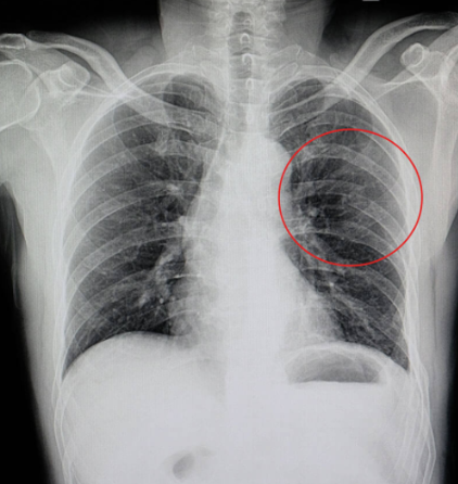 갈비뼈금간-사진3
