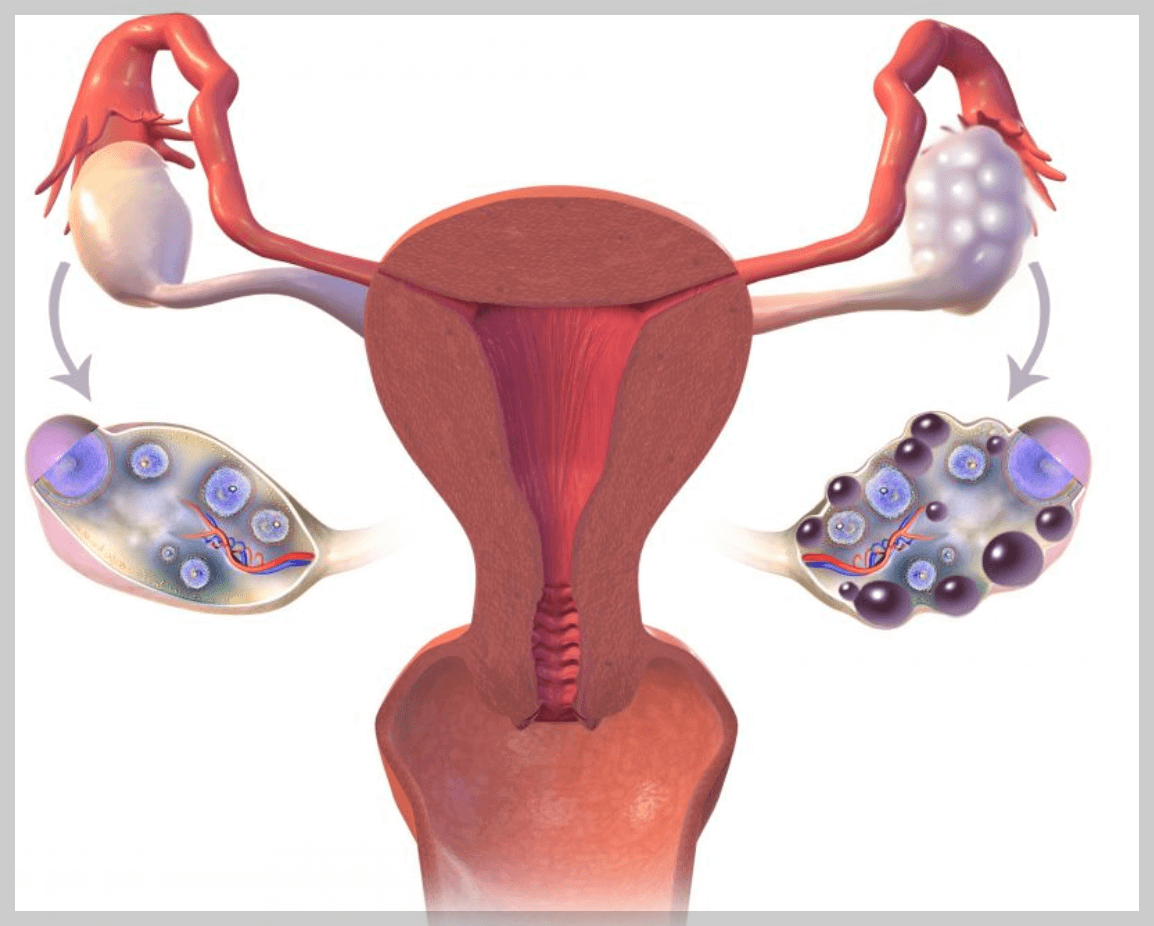 다낭성 난소증후군4