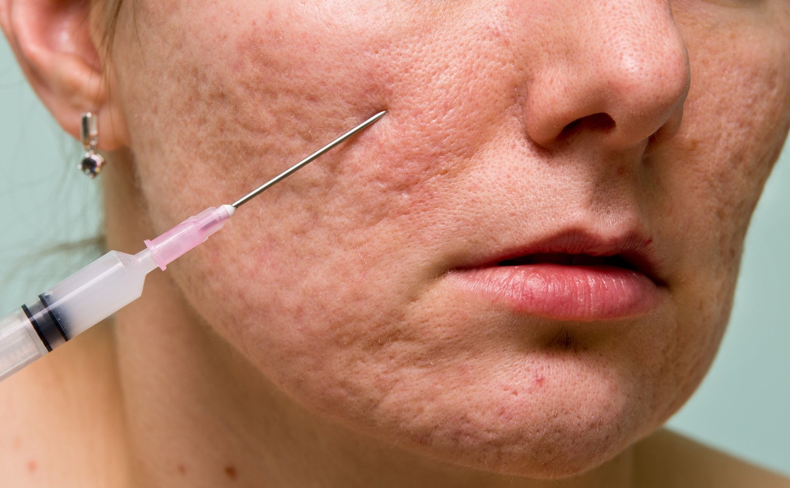 여드름 흉터 치료